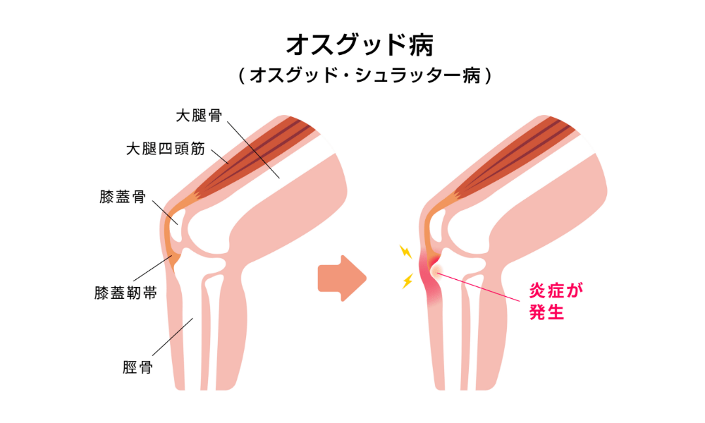 オスグッド病の解剖イラスト