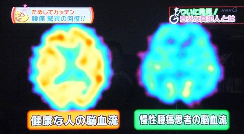 脳の血流
