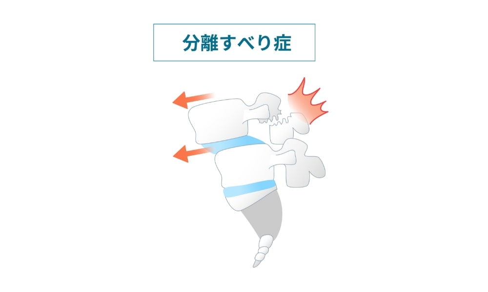 腰椎分離すべり症