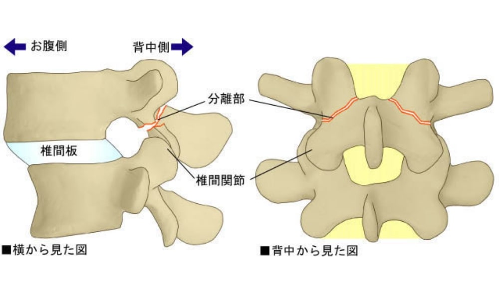 腰椎分離症